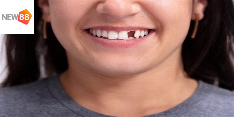 Hình ảnh rụng răng phổ biến